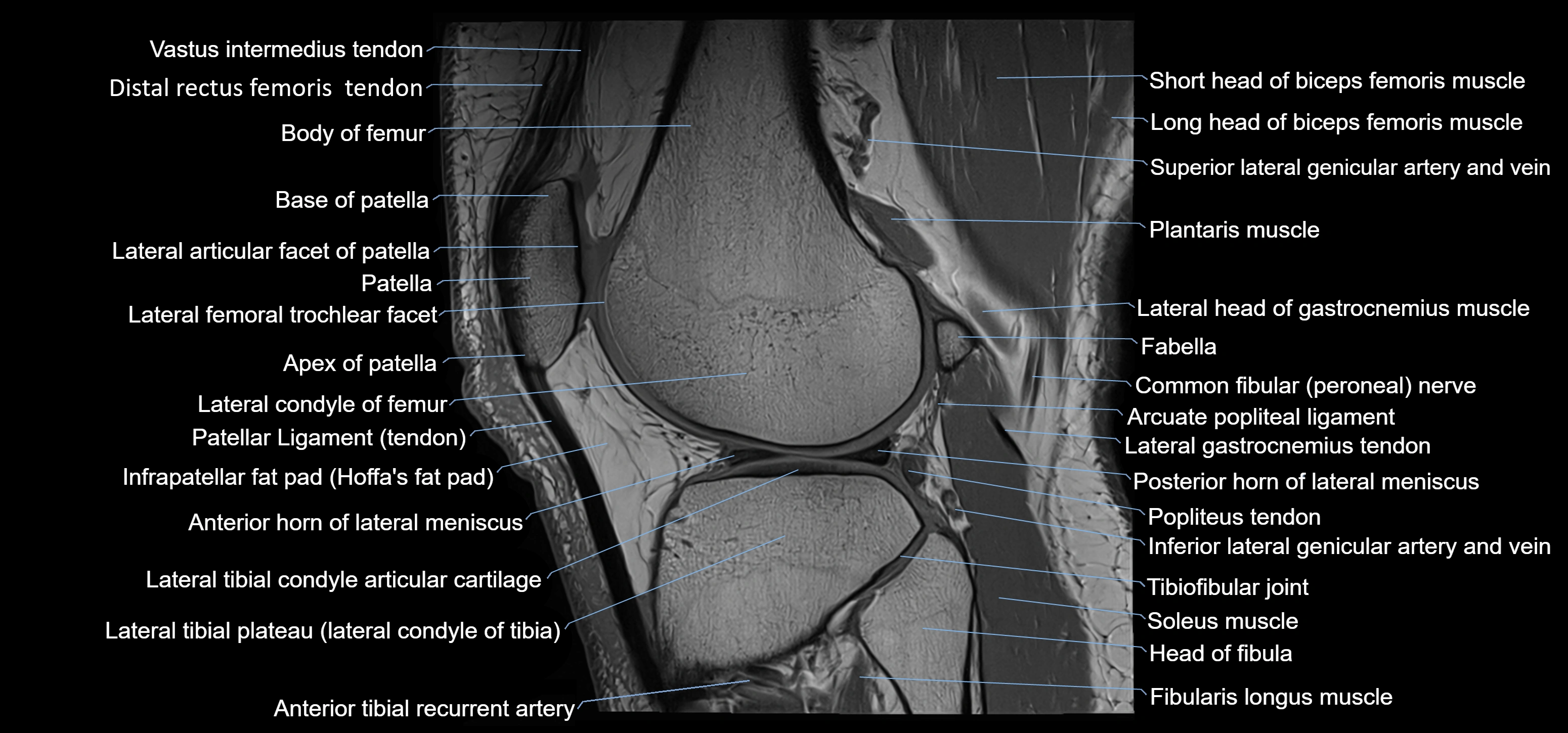 MRI knee sagittal cross sectional anatomy labelled 3T radiology image-00035.webp